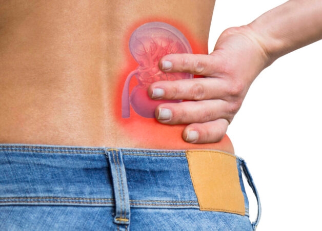 Sỏi thận gây đau lưng thế nào? Cách điều trị