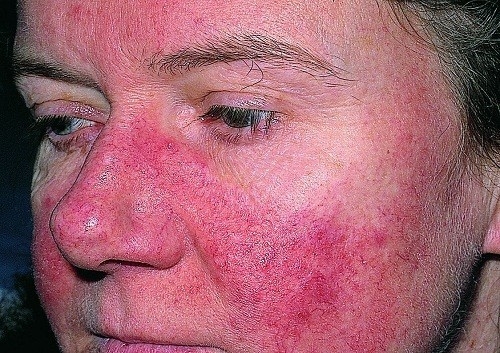 Biểu hiện của bệnh lupus ban đỏ