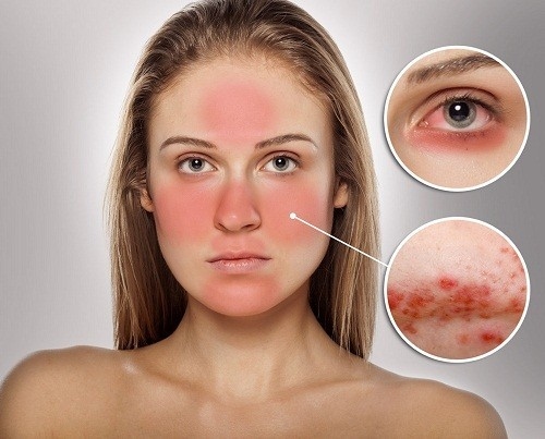 Thời tiết khắc nghiệt, quá nóng hoặc quá lạnh, gió và ánh sáng mặt trời là một trong các yếu tố nguy cơ kích hoạt sự phát triển của chứng đỏ mặt.