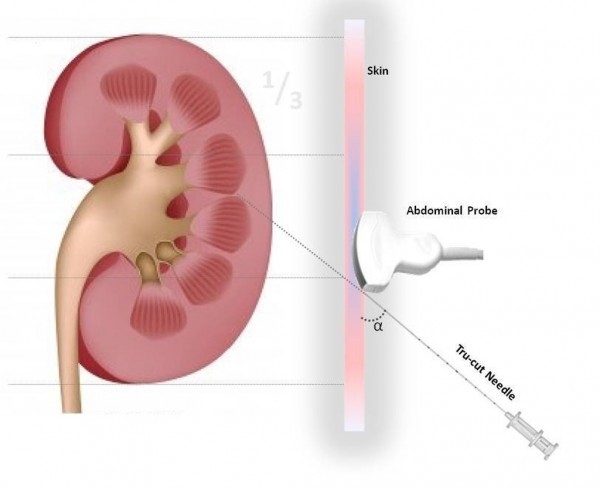 Người bệnh có thể được chỉ định thực hiện sinh thiết thận khi nghi ngờ mắc viêm cầu thận. 