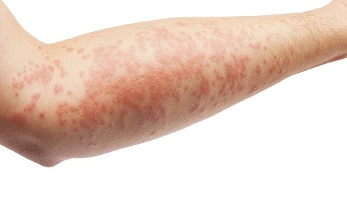 Mục tiêu của điều trị viêm da dị ứng là giảm viêm, giảm ngứa và ngăn chặn bùng phát trong tương lai. 