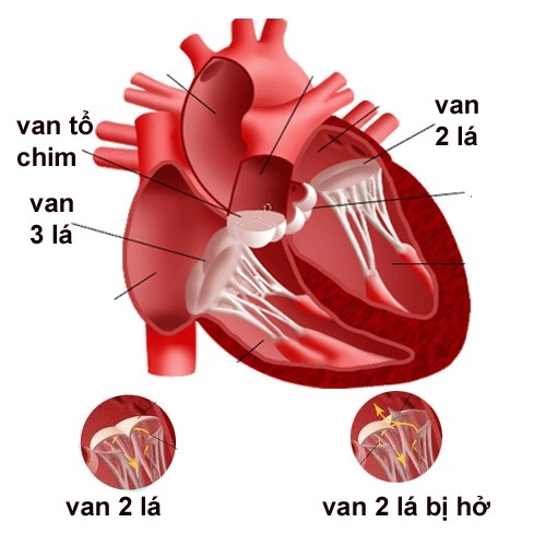 Hẹp van 2 lá có thể sinh con không?