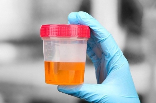 Xét nghiệm chlamydia có thể được thực hiện trên mẫu nước tiểu hoặc mẫu chất dịch thu thập từ các vùng của cơ thể nghi ngờ nhiễm bệnh.