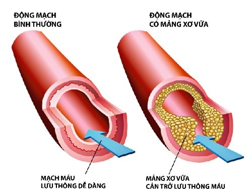 Mỡ trong máu cao là bệnh gì? thấp hơn bình thường