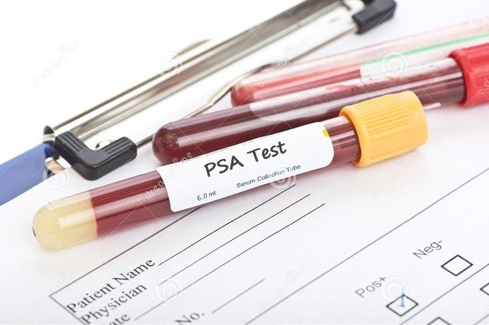 Xét nghiệm máu đo nồng độ PSA có thể giúp phát hiện ung thư tuyến tiền liệt sớm