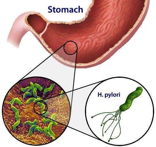 Xét nghiệm virus Hp là gì? có thể lây qua đường ăn uống