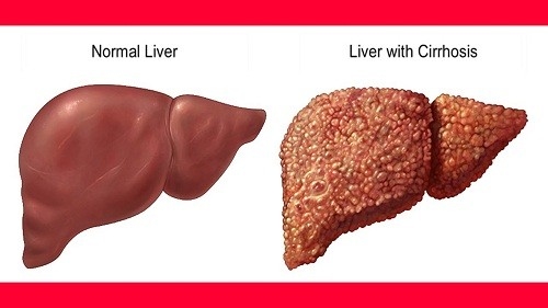 Đặc điểm của xơ gan Xơ gan giai đoạn 1