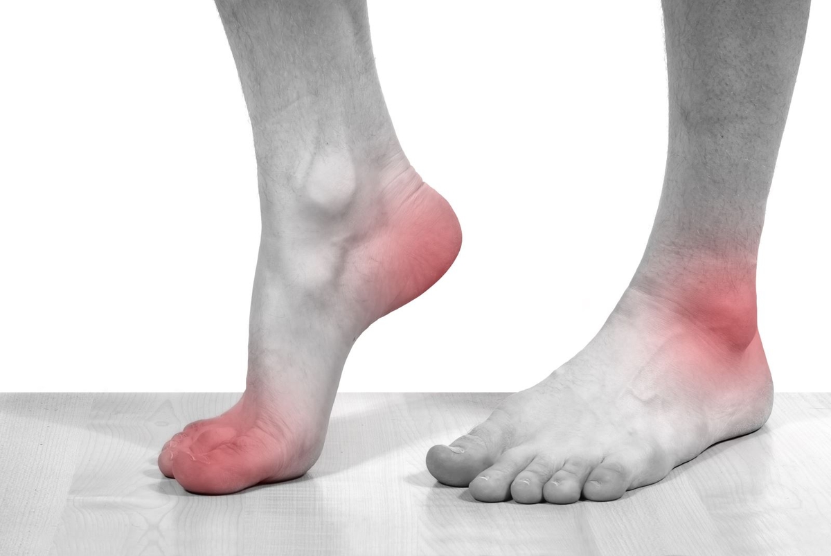 Dấu hiệu của bệnh gút ở bàn chân