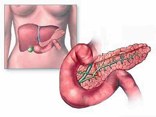 Đau bụng mạn tính là một triệu chứng đặc trưng của bệnh viêm tụy mạn tính. 