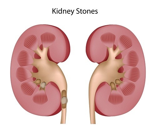 Số lượng nước không đủ hay có sự ứ trệ trên đường đi, các chất cần thải loại sẽ lắng lại, tích tụ theo thời gian và tạo thành sỏi.