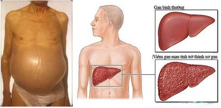 Viêm gan B mạn tính biến chứng thành xơ gan khi không được theo dõi và điều trị