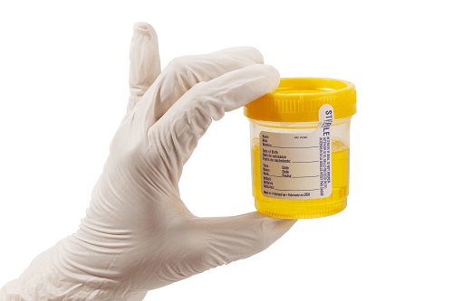 Xét nghiệm acid uric trong nước tiểu được chỉ định cho các trường hợp sỏi thận tái phát hoặc cần được theo dõi về tình trạng tạo thành sỏi.