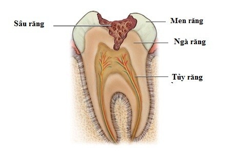 Sâu răng là bệnh lý về răng miệng cần chữa trị càng sớm càng tốt.