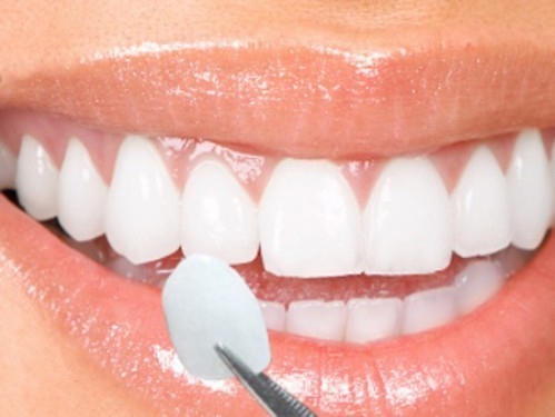 Công nghệ dán sứ trên bề mặt răng tại bệnh viện Thu Cúc giúp bạn nhanh chóng được sở hữu hàm răng sáng bóng như mong đợi.