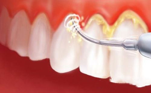 Công nghệ cạo vôi răng tiên tiến nhanh chóng làm sạch các mảng bám chân răng đem lại hiệu quả tối ưu.