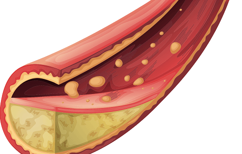 Nồng độ cholesterol trong máu quá cao sẽ làm tăng nguy cơ phát triển bệnh tim mạch.
