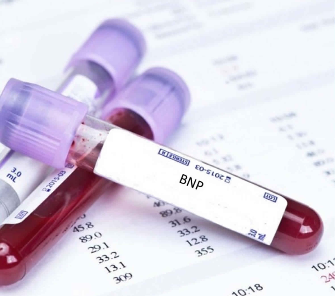 Xét nghiệm BNP hoạt động của trái tim