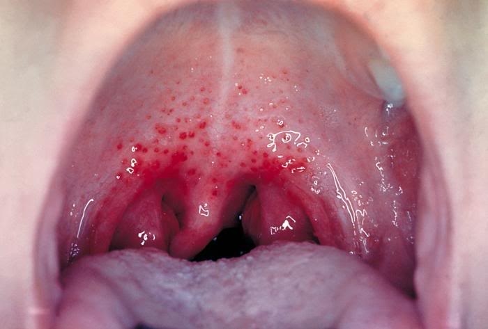 Tìm hiểu về viêm amidan ở trẻ