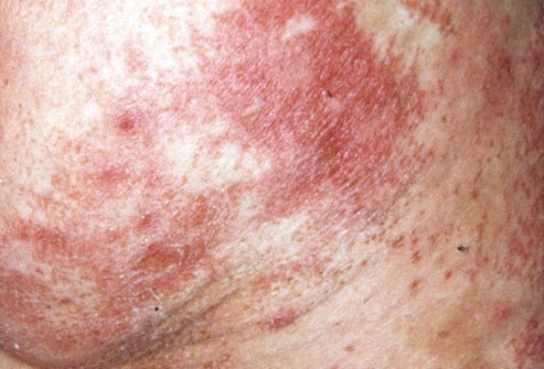 Phát ban có vảy ở mông xuất hiện kèm theo đau và đỏ ở lưỡi, đây có thể là dấu hiệu của khối u ở tuyến tụy.