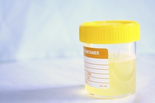 Protein niệu là tình trạng xét nghiệm tìm thấy có protein trong nước tiểu