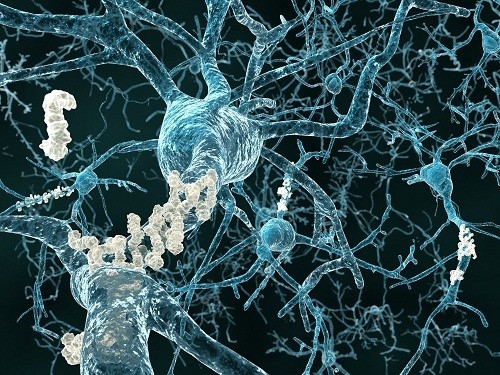 Nguyên nhân gây ra bệnh Alzheimer vẫn chưa được xác định chính xác. 