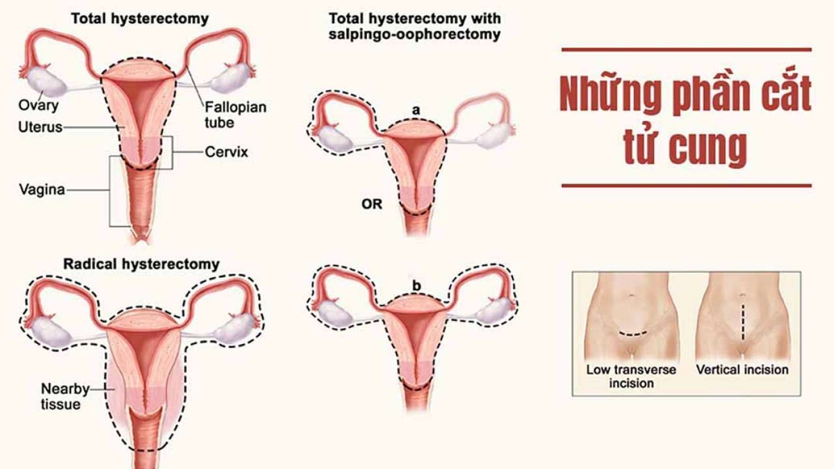 Cắt tử cung bán phần như thế nào?