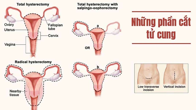 Cắt tử cung bán phần như thế nào?
