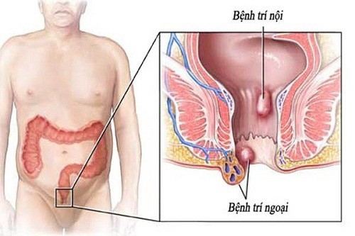 Bệnh trĩ ngoại &#8211; bạn cần biết những gì?
