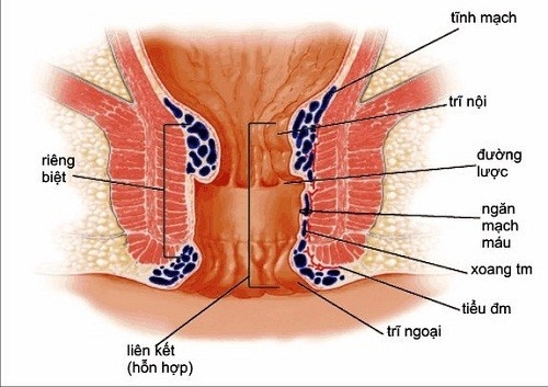 Khi bị trĩ nội, người bệnh sẽ thấy các triệu chứng như chảy máu, đau, ngứa vùng hậu môn...