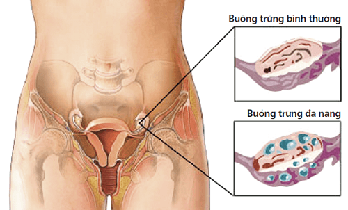Hội chứng buồng trứng đa nang là rối loạn liên quan đến mất cân bằng hormon và kháng insulin