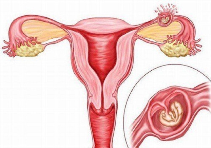 Mổ thai ngoài tử cung nên và không nên ăn gì?