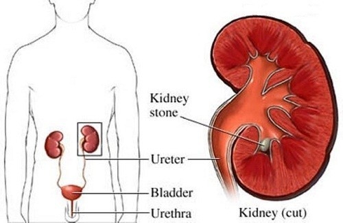 Tìm hiểu tổng quan về sỏi niệu quản đang phổ biến hiện nay