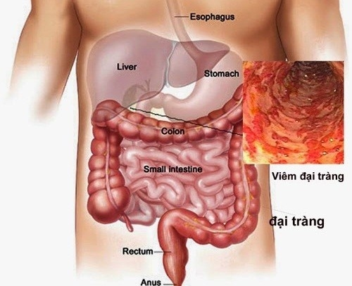 Viêm đại tràng co thắt là bệnh phổ biến, thường gây đau ngay sau ăn hoặc sau khi ăn no, ăn những thức ăn lạ, đồ chua, cay, lạnh.