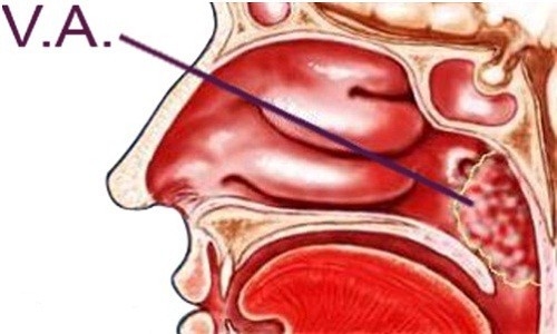 VA là bệnh gì? Đó là một tổ chức lymphô nằm ở vòm mũi họng. VA có chức năng miễn dịch và sản xuất kháng thể chống lại vi khuẩn xâm nhập đường hô hấp trên