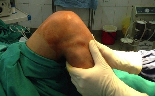 Phẫu thuật tái tạo dây chằng chéo trước gối là giải pháp an toàn, hiệu quả cho những trường hợp bị đứt dây chằng