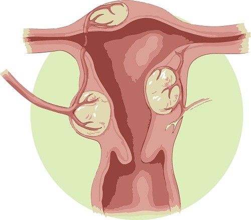 Nhiều chị em chưa biết rõ nhân xơ tử cung là gì mặc dù đây là một căn bệnh thường gặp ở phụ nữ trên 30 tuổi. 