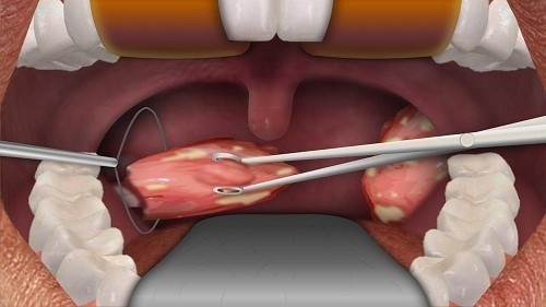 Có nhiều cách khác nhau để phẫu thuật cắt bỏ amidan. Việc lựa chọn cách thức nào tùy thuộc vào tình trạng cụ thể của người bệnh.