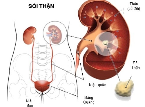 Sỏi niệu quản có nguy hiểm không?
