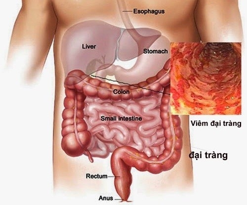 Triệu chứng đau đại tràng