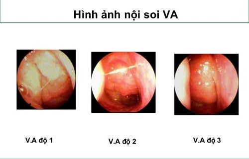 VA quá phát là tình trạng tái đi tái lại nhiều lần ảnh hưởng tới sức khỏe