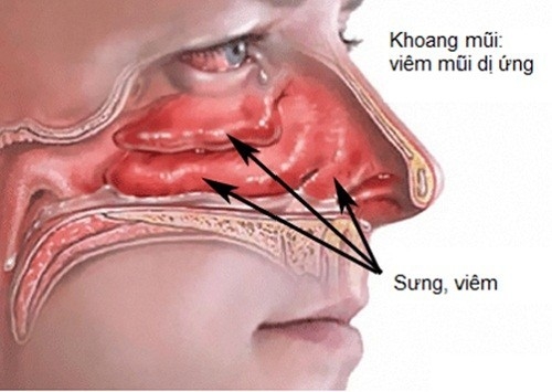 viem-mui-xoang-di-ung1