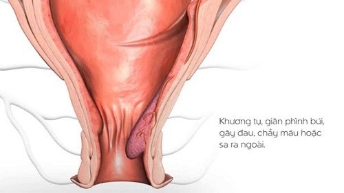 Biến chứng của bệnh trĩ Bệnh rất phổ biến ở cả nam và nữ