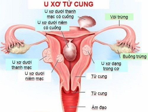 U xơ tử cung là khối u lành tính nhưng cần được hỗ trợ điều trị kịp thời mới giúp ngăn ngừa biến chứng nguy hiểm