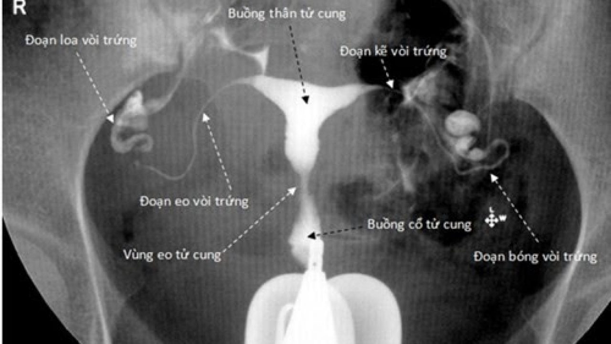 Chụp tử cung vòi trứng và những điều chị em cần biết