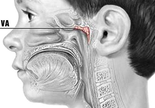 Tùy sự nhạy cảm của hệ miễn dịch của trẻ, VA có thể bị viêm và có các triệu chứng nghẹt mũi, khó thở...