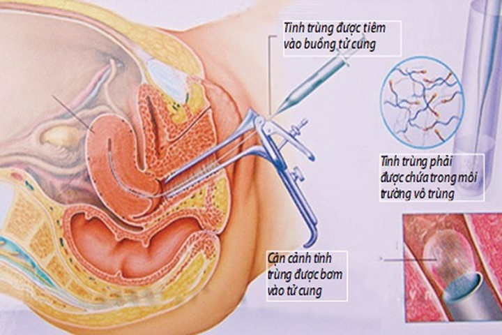 Kỹ thuật thụ tinh nhân tạo IUI &#8211; Hy vọng mới cho các cặp vợ chồng hiếm muộn