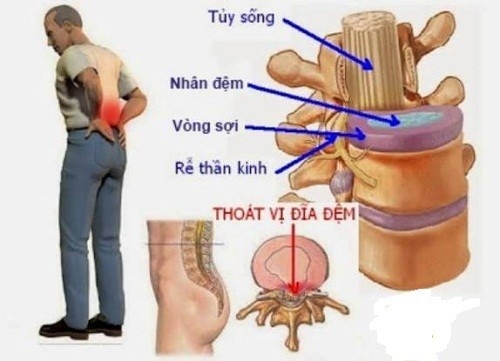 Triệu chứng bệnh thoát vị đĩa đệm