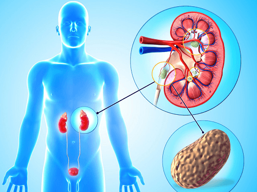 Phẫu thuật lấy sỏi thận Tại Bệnh viện Thu Cúc
