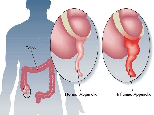 Bệnh viêm ruột thừa (đau ruột thừa) là hiện tượng phần ruột thừa bị viêm và lên mủ, dẫn đến việc đau, khó chịu cho người bệnh. 