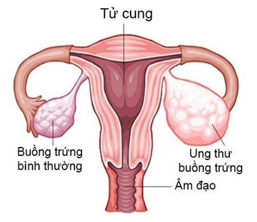 Siêu âm buồng trứng có phát hiện được ung thư không?